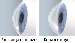 Кератоконус глаза